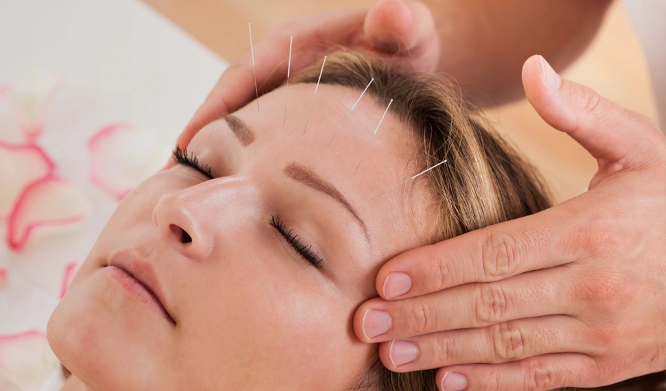 Activation des points d’acupuncture